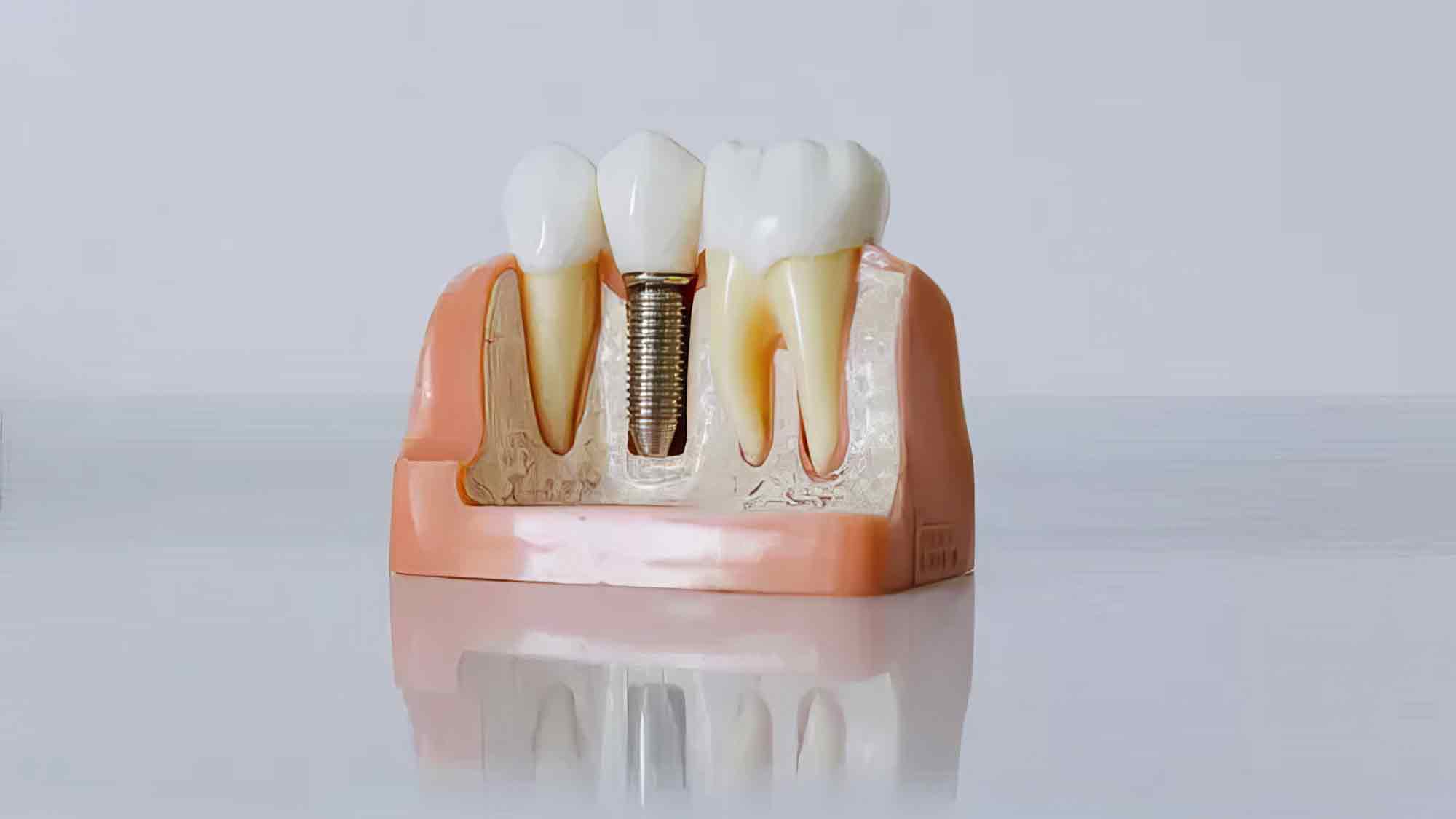 Warum viele Zahnärzte aktuell Keramik Implantate für die beste Wahl halten Warum viele Zahnärzte aktuell Keramik Implantate für die beste Wahl halten