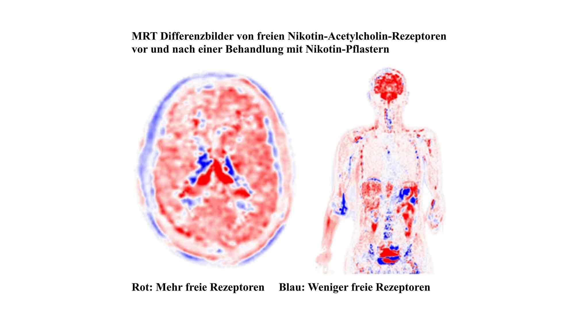 Long Covid: Behandlung mit Nikotinpflastern kann sehr vielen helfen hat aber zwischenzeitliche Nebenwirkungen Long Covid: Behandlung mit Nikotinpflastern kann sehr vielen helfen hat aber zwischenzeitliche Nebenwirkungen