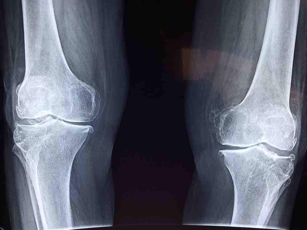 Klinikum Gütersloh: Wenn die Endoprothese wackelt – wie lange hält ein künstliches Gelenk und wann ist ein Wechsel notwendig? Klinikum Gütersloh: Wenn die Endoprothese wackelt – wie lange hält ein künstliches Gelenk und wann ist ein Wechsel notwendig?