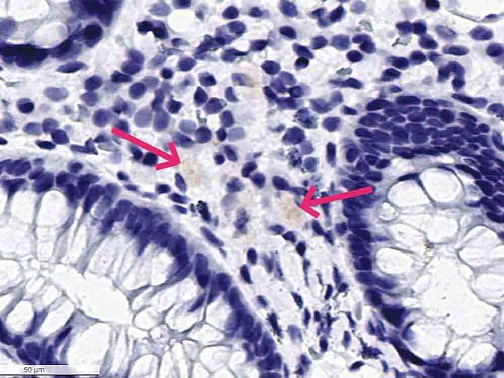 Covid 19: Schützen sie ihre Kinder vor Autoimmunerkrankungen wie Diabetes und CFS nach der Infektion Covid 19: Schützen sie ihre Kinder vor Autoimmunerkrankungen wie Diabetes und CFS nach der Infektion