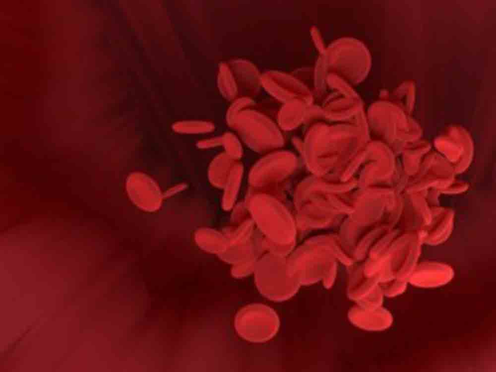 Alzheimer, Blut Austausch als Therapie, US Studie, Bildung von Amyloid Plaques im Gehirn von Mäusen deutlich geringer