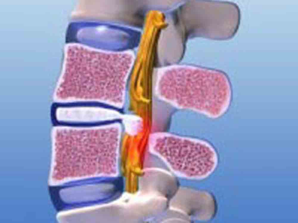 Schnell wirksame Schmerzlinderung bei einem akuten Bandscheibenvorfall, Apex Spine Center Schnell wirksame Schmerzlinderung bei einem akuten Bandscheibenvorfall, Apex Spine Center